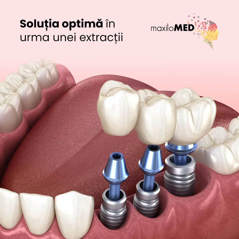 Implant dentar - Solutia optima in urma unei extractii dentare clinica maxilomed oradea