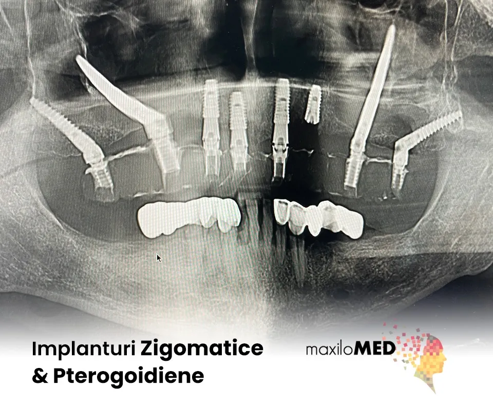 Implanturi Zigomatice si Pterigoidiene clinica maxilomed oradea dr Mihai Juncar dr Adrian Gabara bucuresti