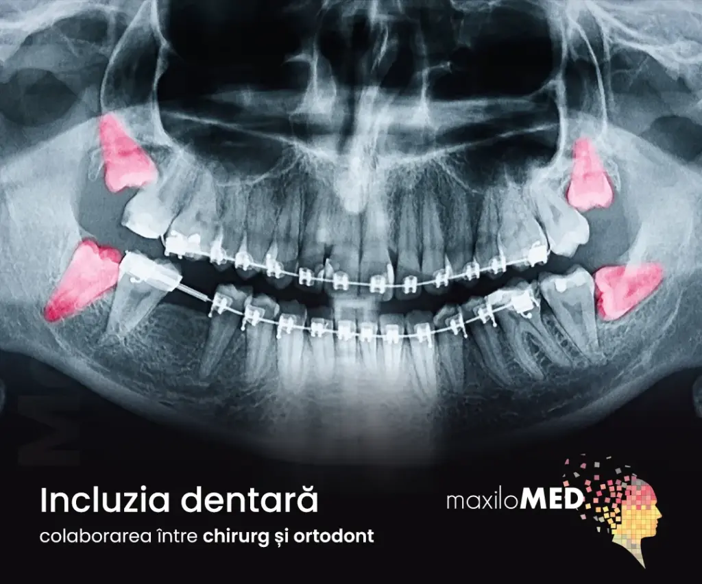 Incluzia dentară un succes garantat prin colaborarea între chirurg și ortodont oradea clinica maxilomed