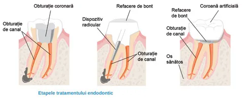 Tratament Endodontic vs Extractie clinica maxilomed oradea