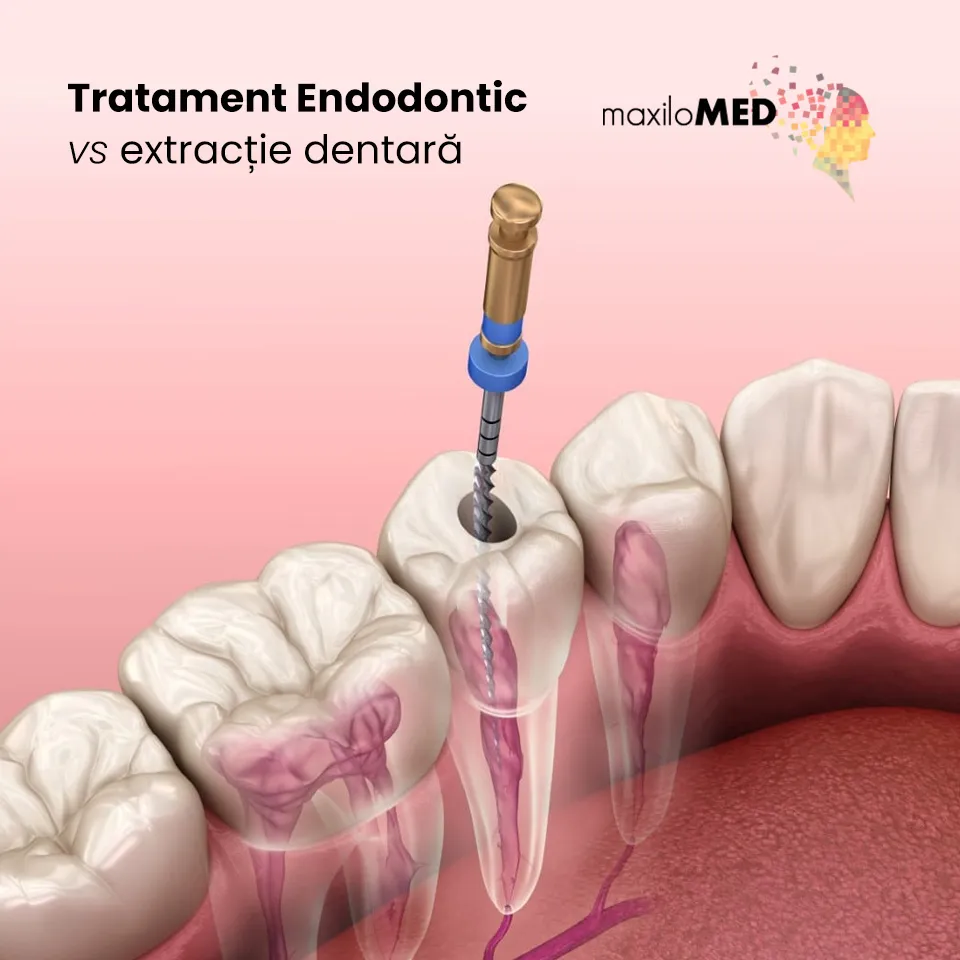 Tratament Endodontic vs Extractie clinica maxilomed oradea
