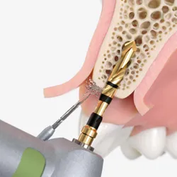 pregatire inserare implant dentar oradea clinica dentara maxilomed